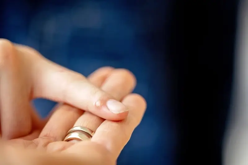 Czy podolog usuwa kurzajki?