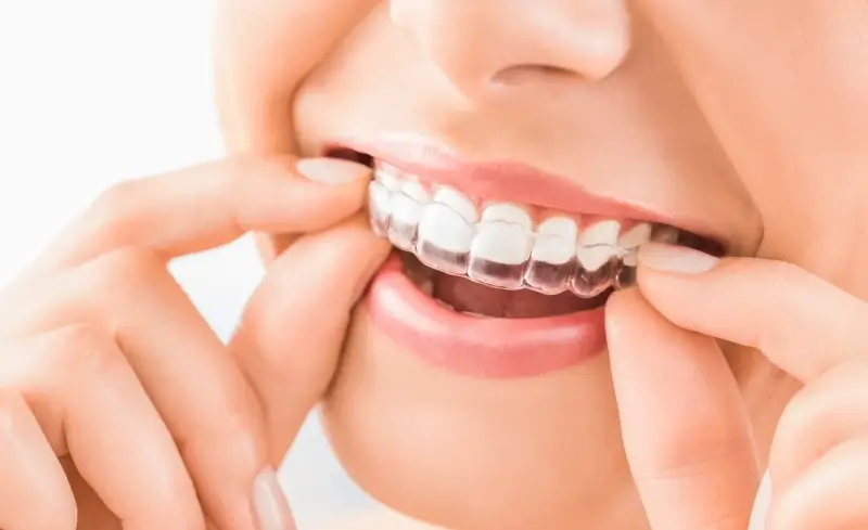Nakładki ortodontyczne Invisalign